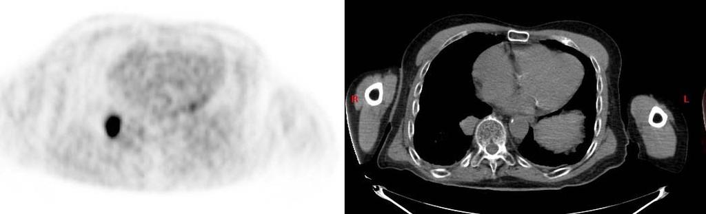 Lung Mass on PET-CT Focal area of increased FDG uptake on