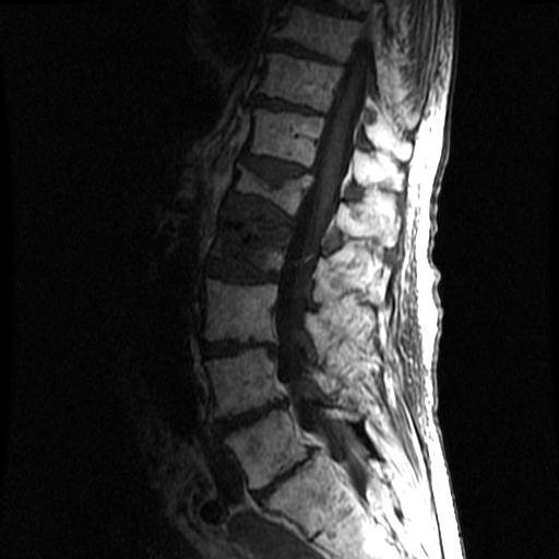 Mr. H: Vertebral Metastases on Spinal MRI Compression fracture L1 T11 L2 From PACS, BIDMC Sagittal T1 MRI