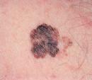 Malignant Melanoma Neoplasm of pigment-forming cells, melanocytes,, and nevus cells Types of