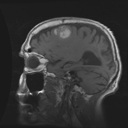 Mr. H: Cerebral Mets on MRI Sagittal T1