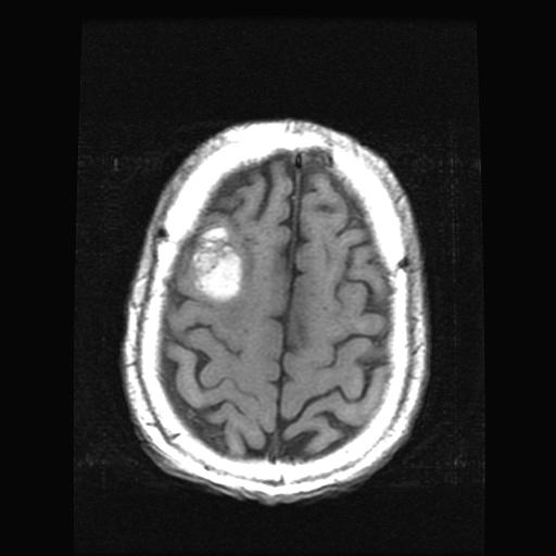 weighted non-contrast brain MRI 2X3 cm area of