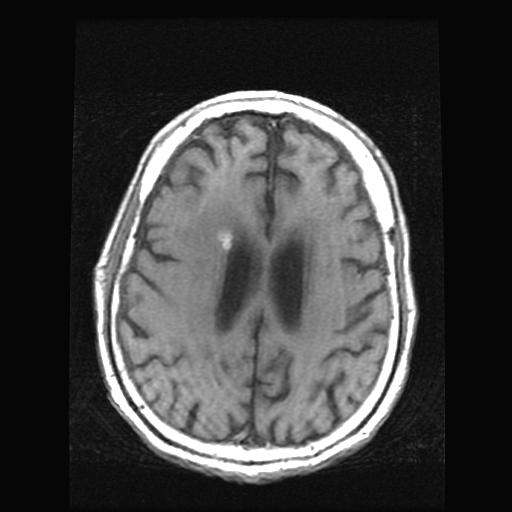Mr. H: Cerebral Mets on MRI Axial T1 weighted non-contrast brain MRI Two