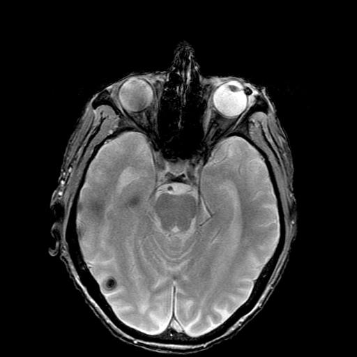 Mr. H: Hemorrhagic Cerebral Mets on MRI Axial T1 weighted non-contrast brain MRI Axial T2 GRE Increased signal intensity
