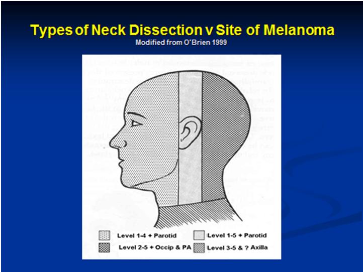 42 Treatment of Metastatic Melanoma In order to provide a guidline for management of the neck in H&NMM we have modified the figure from O Brien and colleagues (O Brien, 1999) to provide some general