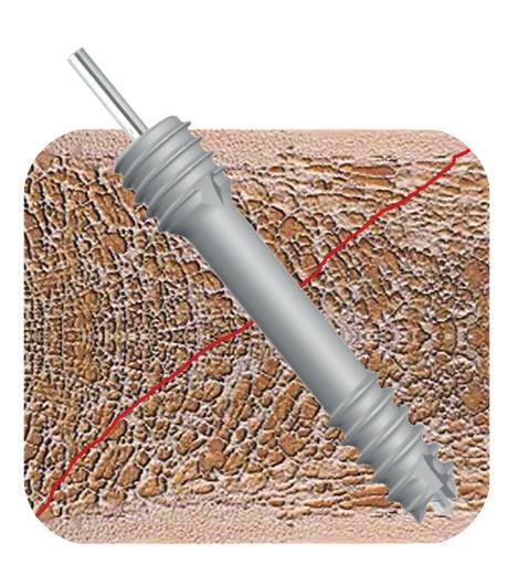 head-end implant sites should now be expanded with a countersink via the still-underlying guide wire.