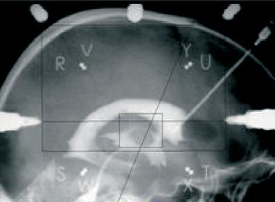 third ventricle, top of the thalamus (at the floor of the lateral ventricle), and midline.