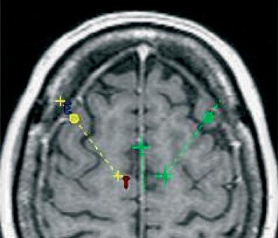 (H,I) Post-operative imaging of the permanent electrodes show that they are mainly symmetrical.