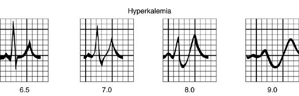 Hyperkalemia Hyperkalemia - burn & trauma - usually small K+ - cardiac arrest -