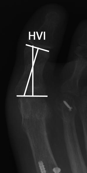 905 Fig. 8 AP radiograph of the proximal phalanx denoting the hallux valgus interphalangeus angle. A line is drawn parallel to the proximal and distal articular surfaces.