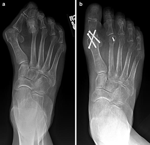 907 Fig. 10 This patient has a significant hallux valgus deformity with hallux rigidus and pain within the first MTP joint.