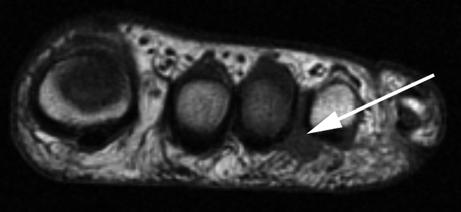 912 A.R. Kadakia et al. Fig. 15 Coronal T1 image of a Morton s neuroma ( arrow ).