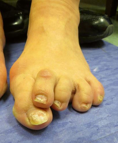 916 A.R. Kadakia et al. Fig. 20 Crossover toe deformity of multiple toes in a patient who has longstanding hallux valgus deformity. Note how the toe has deformity in multiple planes.