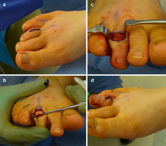 918 A.R. Kadakia et al. Fig. 21 PIP arthroplasty for a patient with a rigid hammer toe deformity of the fourth ( a ).