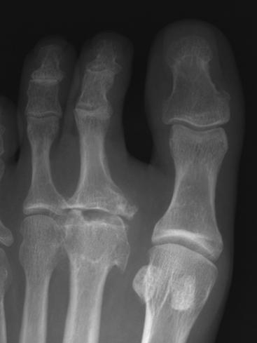 This patient had a prior silicone arthroplasty of the great toe and developed Freiberg s disease secondary to overload