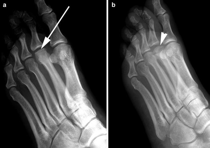 27 Radiograph of a patient with Freiberg s disease ( a ) with the characteristic flattening of the