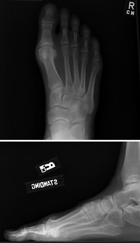 897 Fig. 1 AP and lateral view of a patient with hallux rigidus.