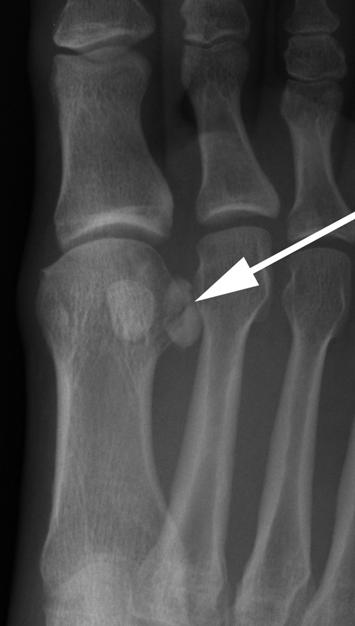 925 Fig. 28 Oblique view of the foot demonstrating a linear lucency within the fibular sesamoid ( arrow ).
