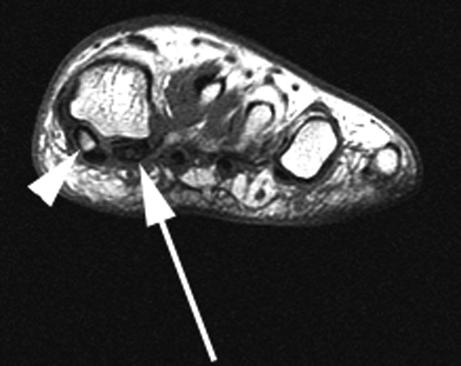 926 A.R. Kadakia et al. Fig. 30 Coronal T1 image of a patient with osteochondritis of the fibular sesamoid.