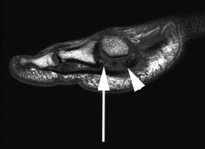 Note the disruption of the distal attachment of the plantar plate ( arrow ) with proximal retraction of the sesamoids ( arrowhead ) Treatment Turf Toe Grade 1: stiff insole with immediate return to
