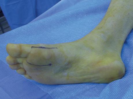 927 Fig. 32 Plantar medial and plantar lateral incisions for repair of a Grade 3 turf toe injury Fig.