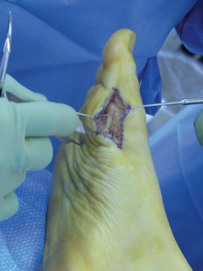 (pictured) Operative Turf Toe Dual incision technique to repair the plantar plate (Fig. 32 ).