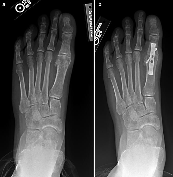 901 Fig. 4 Patient with grade 4 hallux rigidus ( a ) (>50 % joint space loss with central grind). This is best treated with an arthrodesis ( b ) Pathoanatomy Medial capsular attenuation.