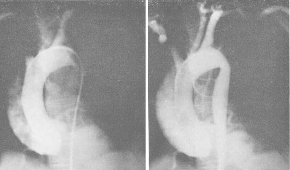 Aortic Regurgitation from Dissection ical features consisted of excruciating chest or intrascapular pain associated with prostration and anxiety but without significant shortness of breath.