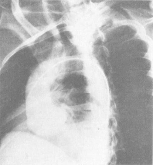 NAJAFI ET AL. FIG. 2. Normal aortogram in a patient with dissection of the entire ascending aorta.