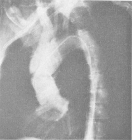 Aortic Regurgitation from Dissectzon within one hour. In these patients, not only was the diagnosis certain but also the extent of the dissection was obvious.