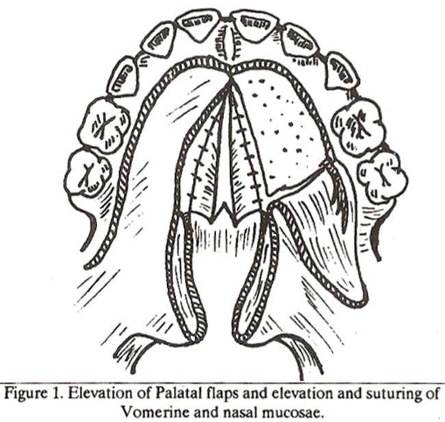 A superiorlybased pharyngeal flap was formed 11.
