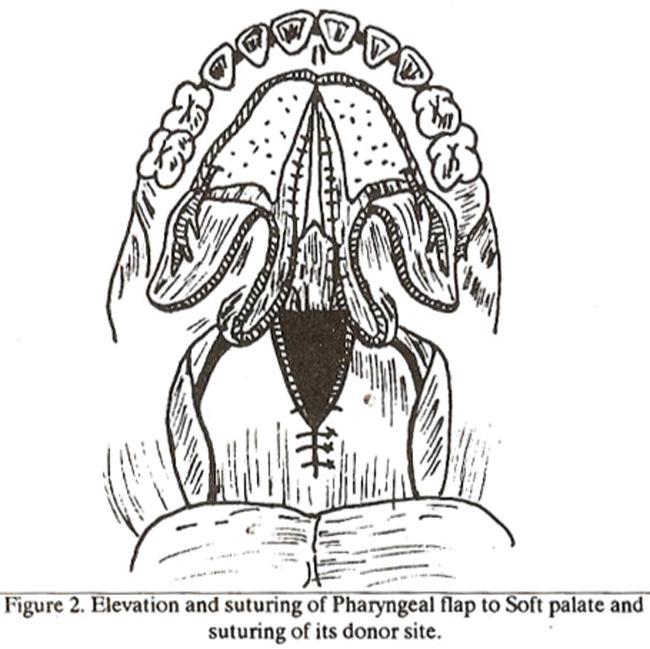 The muscles of the soft palate were approximated with deep sutures. The oral mucosal layer over the full length of palate was then closed with interrupted 4x0 black silk.