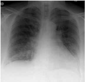 et al, Am J Respir Crit Care 2012, 186:325. Case #1 63 y/o woman with h/o breast CA is admitted January 2014 with fever, cough, and shortness of breath.