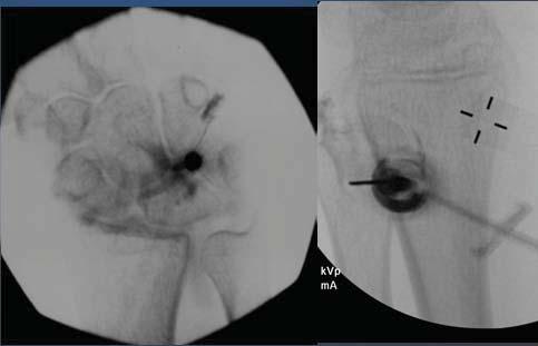 arthropathies Radiographs are helpful for providing prognostic and baseline