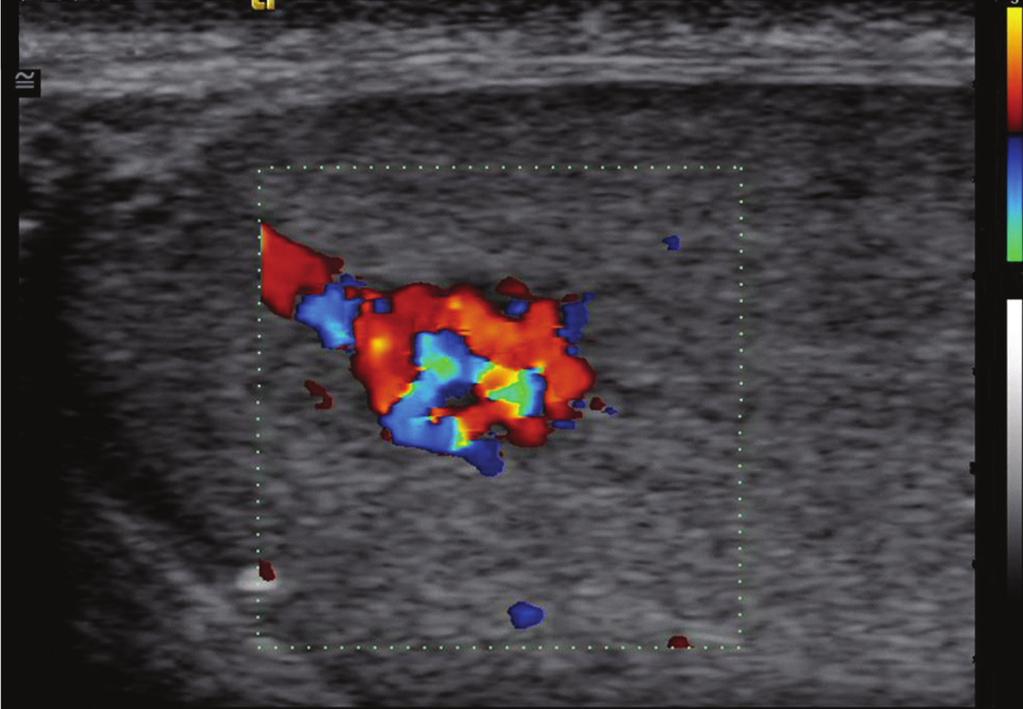 have slower flow or lesser degrees of vascular pooling. Another reported color Doppler US feature is the presence of a low resistance pattern probably representing arteriovenous shunting [10].