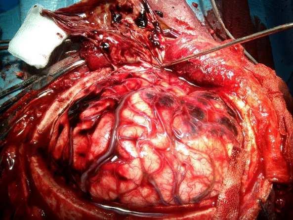 Romanian Neurosurgery (2014) XXI 2: 188-194 193 Measures are taken in order to treat