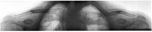 osteitis fibrosa - demineralization - fractures