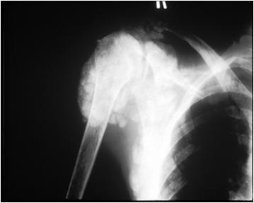 Periarticular Calcification Possible Effect of
