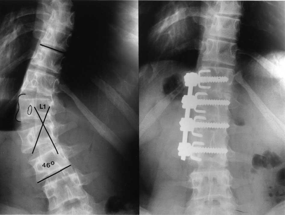 Thoracolumbar and lumbar curves are best suited to anterior correction where the intervertebral discs are completely excised and internal fixation is achieved by linked trans-vertebral screws.