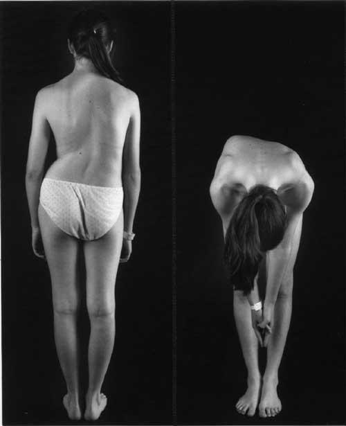 The physical signs of AIS The signs are readily seen when the trunk is viewed from behind with the subject standing erect (Figure 1). 2004 Scoliosis Australia Figure 1. Left.