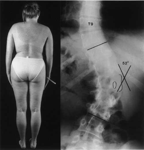 cosmetic blemish. It is remarkable how little outward deformity even major lumbar curves may produce, especially in overweight girls. 2004 Scoliosis Australia Figure 2.