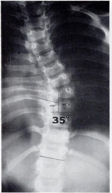 PROGRESSIVE AND RESOLVING INFANTILE IDIOPATHIC SCOLIOSIS 649 The best differential diagnosis previously available has been limited to an appreciation that a curve already severe will inevitably