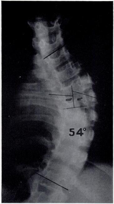 The other feature thought to indicate a progressive scoliosis was the development of compensatory curves above and below the primary curve. When FIG.