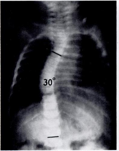 PROGRESSIVE AND RESOLVING INFANTILE IDIOPATHIC SCOLIOSIS 651 significant difference could arise. For the measurement a radiograph taken in the supine position to give greater clarity was used.
