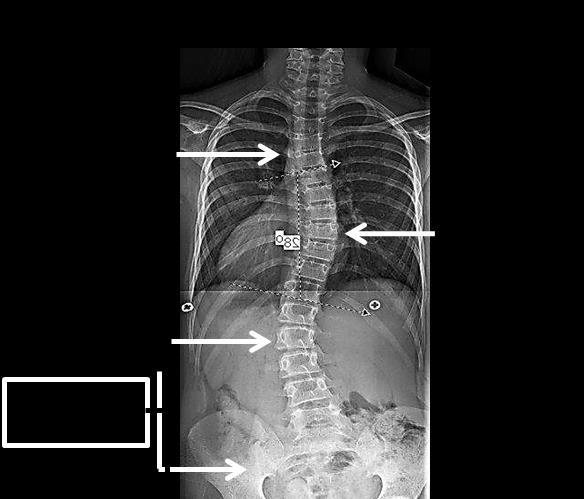 CBB Type II Type II -Thoracic Primary-curvatures are also S -shaped. Again, both the thoracic and lumbar components cross the horizontal midline.