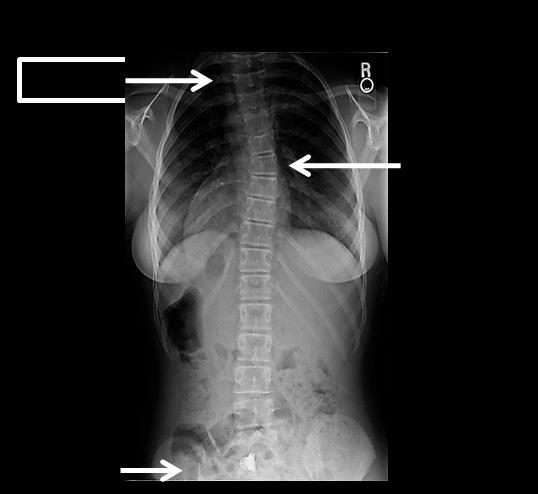 9 Applied Force: The correction method for Type III is less difficult than Type II because by definition the Lumbar vertebra will not cross the midline or tilt in the opposite direction of the curve