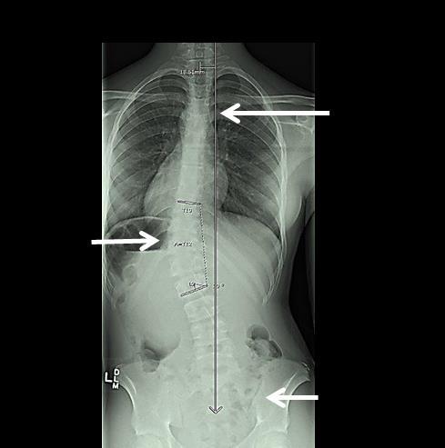 CBB Type IV Type IV-Single Thoracolumbar / Lumbar- scoliosis is characterized by long thoracic (thoracic /thoracolumbar) curves in which the body of L-5 is centered over the sacrum but the body of