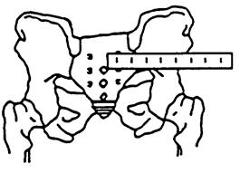 Sacrum visible Locate and mark a spot at the center of S-2. With a straight edge, measure the distance from the mark to the edge of the X-ray. (Fig. 4) Fig.
