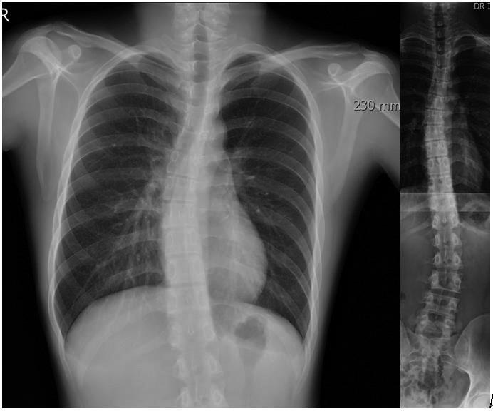 Chang Hyun Oh, et al. physicians on the curve of the thoracic spine, and therefore, chest radiographs has been reported to be useful in scoliosis screening.