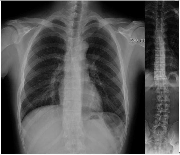 Today, the exact usefulness and limitation of screening programs by chest radiograph for early detection of scoliosis have so far not been examined.