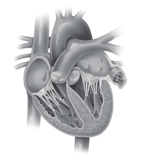 WATCHMAN Left Atrial Appendage Closure Device PATIENT INFORMATION GUIDE Your doctor has recommended that you consider undergoing a procedure to receive the WATCHMAN Implant or you have recently had a